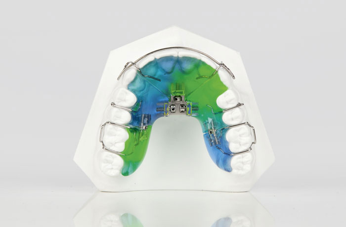 Lose Spange Klammer lose bunt Kind Apparatur Kieferorthopäde