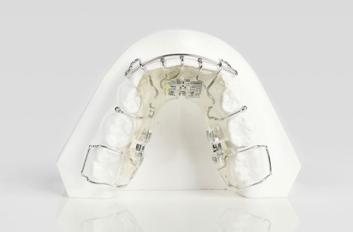 Lose Zahnspange farblos Zahnspange Kind unauffällig