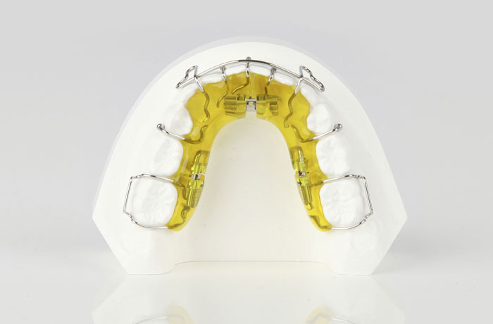 Lose Zahnspange leuchtend gelb Platte leuchtend gelb